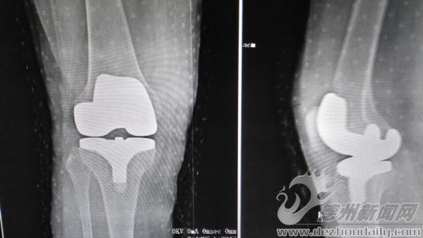 風濕性關節(jié)炎新選擇 術后恢復要注意